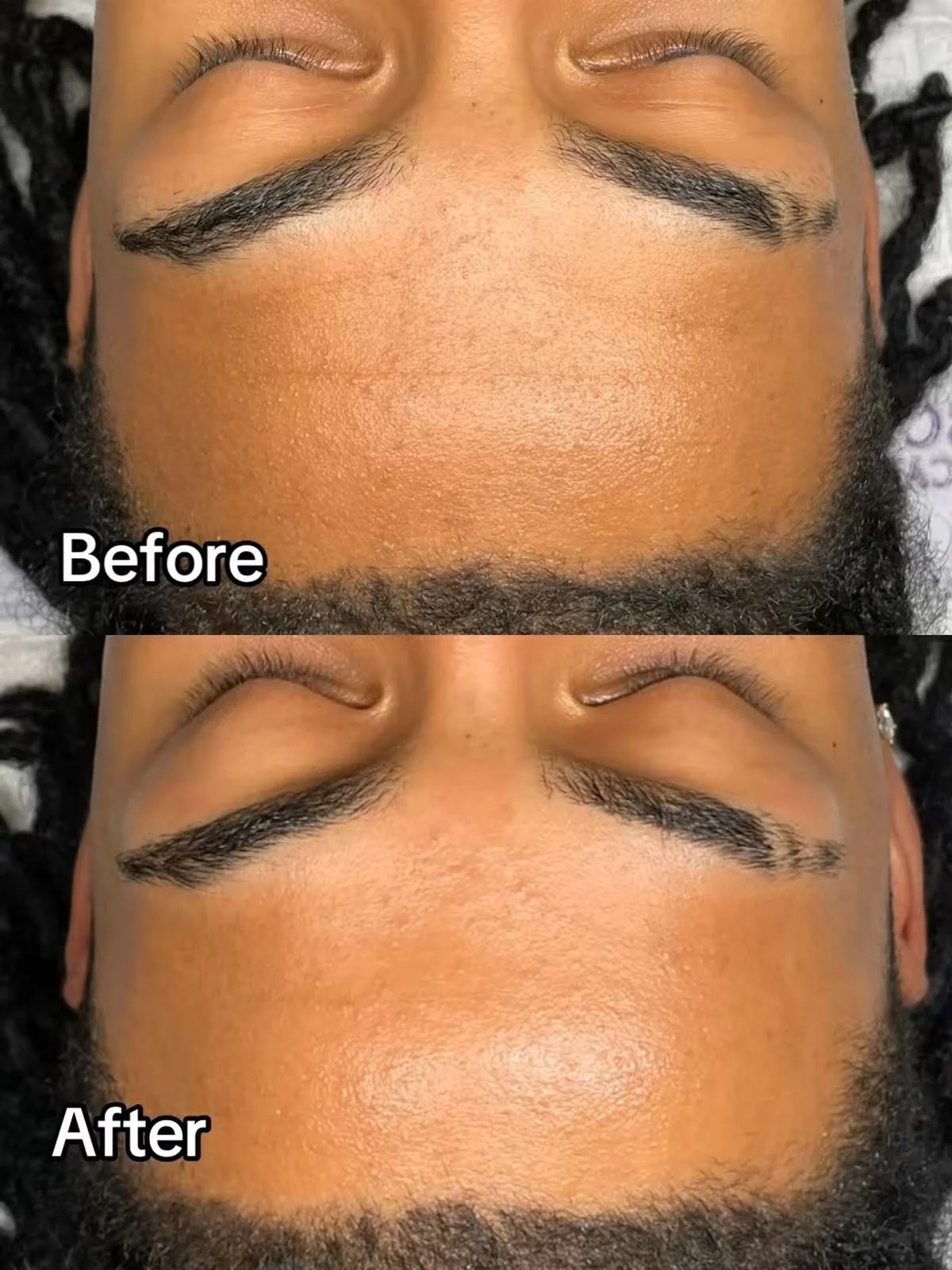 Healthy Aging Facial Before and After