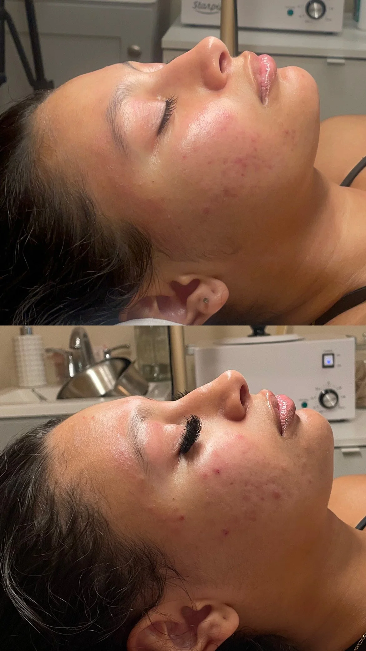 Acne Facial Before and After
