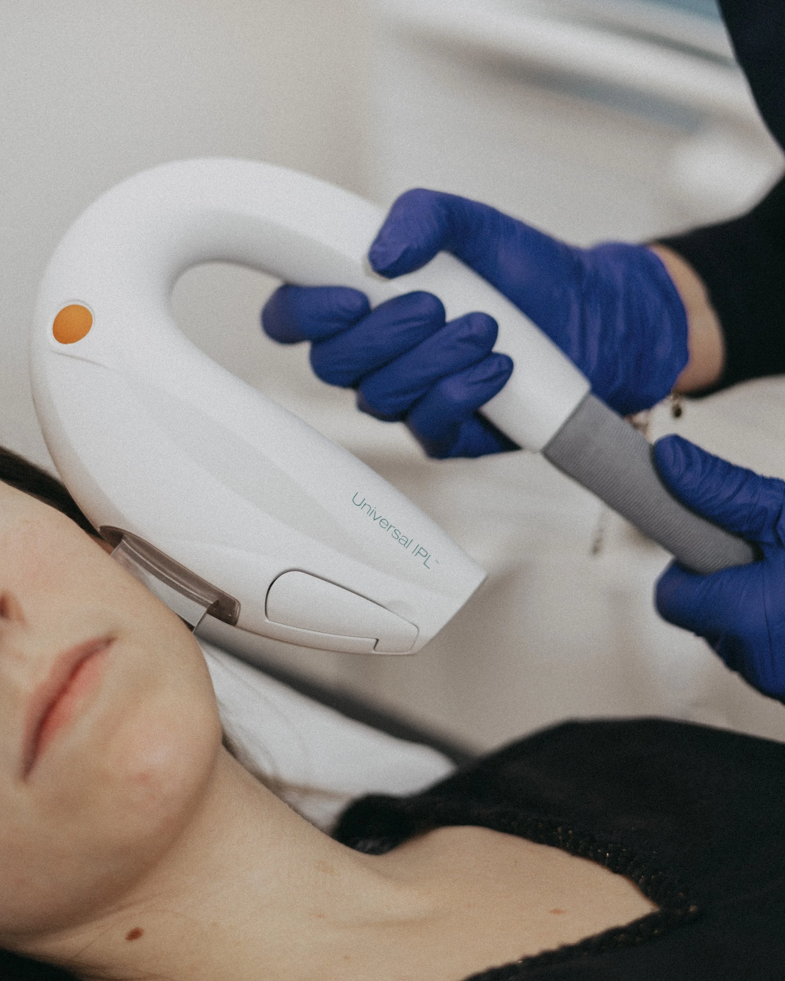 Traitement IPL à Lyon, taches et couperose, Dr Cloé Durdilly