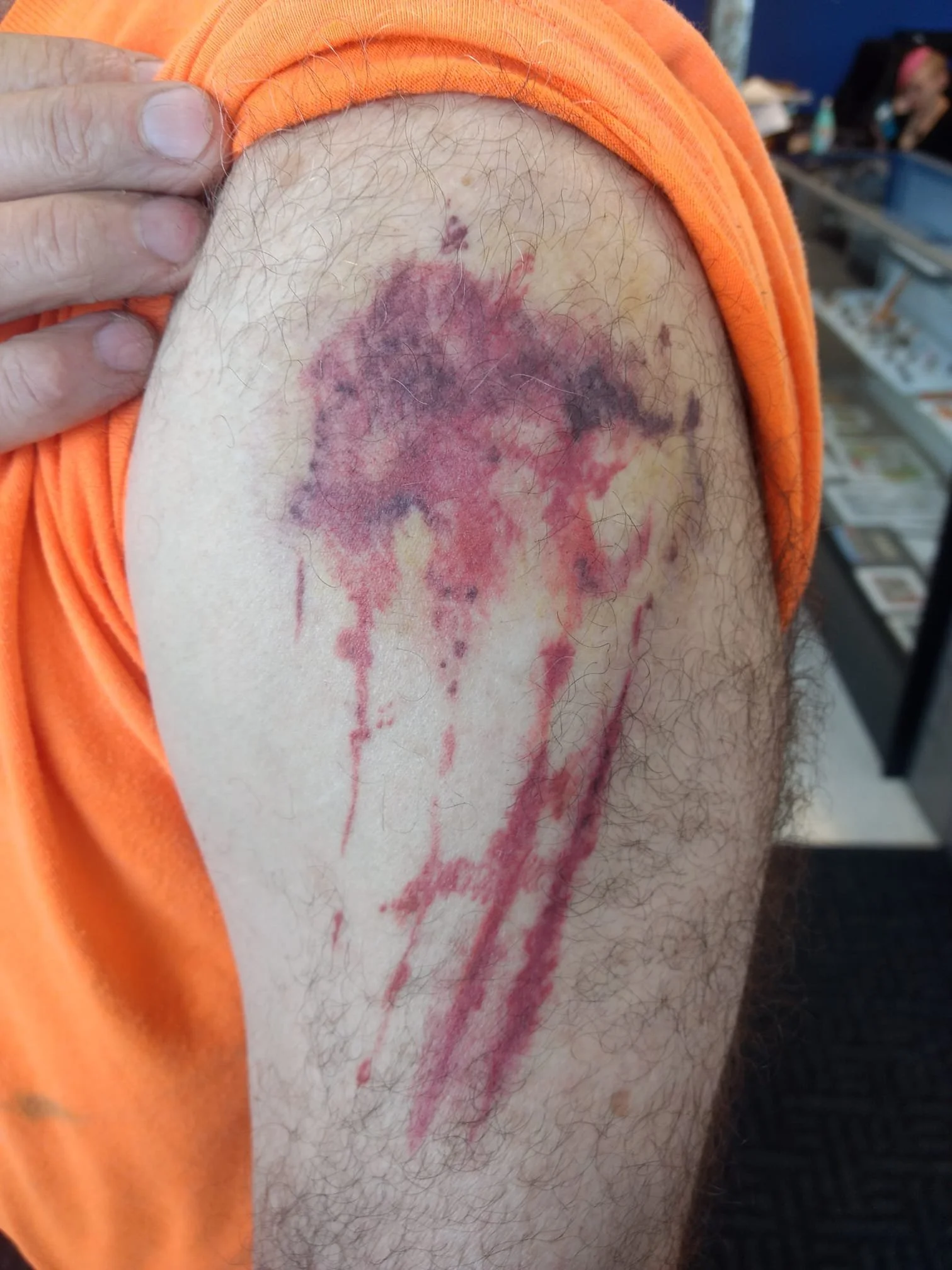 Close-up of a person's upper arm with visible hair and a large, irregular bruise with purple, red, and black discoloration, and blood appearing to be oozing or smeared. Or it's a tattoo I did