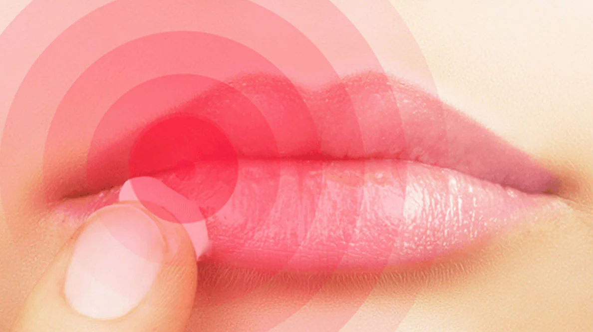 Get Rid of Cold Sores Fast Naturally