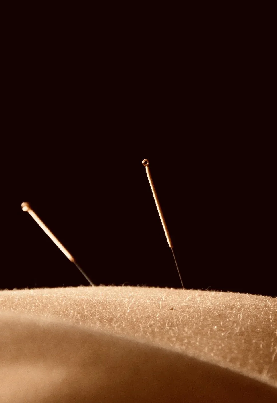 Dry Needling Massage