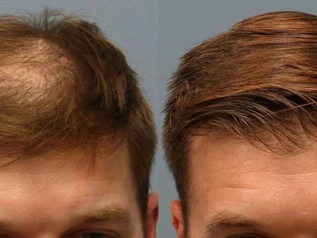 Before and after results of a Sapphire FUE hair transplant performed in Turkey.