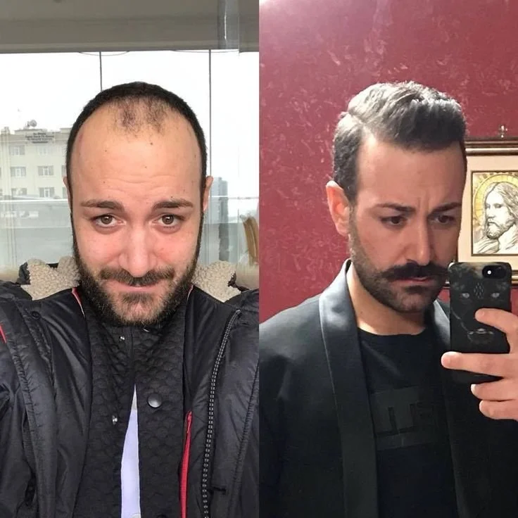 Before and after hair transplant transformation demonstrating significant crown density improvement and graft success.