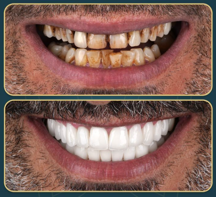 Before and after full smile makeover with porcelain veneers in Turkey.