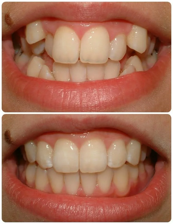 Porcelain veneers before and after results showing a natural smile makeover for a patient in Turkey.