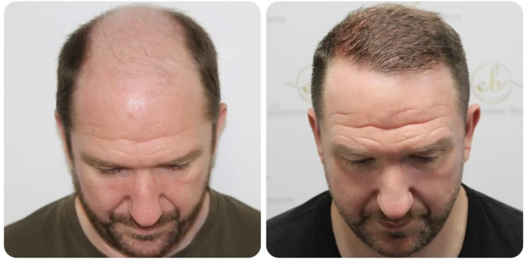 Successful hair transplant transformation for a US patient traveling to Turkey for medical tourism.