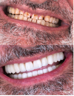 Hollywood smile makeover before and after results from our expert partner dental clinics in Turkey.