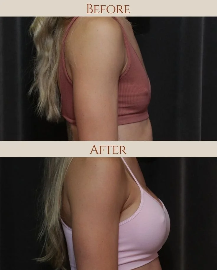 Expert breast surgery results managed by our Scottsdale consulting team for patients traveling to Turkey.
