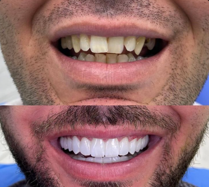 Digital smile design transformation before and after, showcasing full cosmetic restoration and alignment.