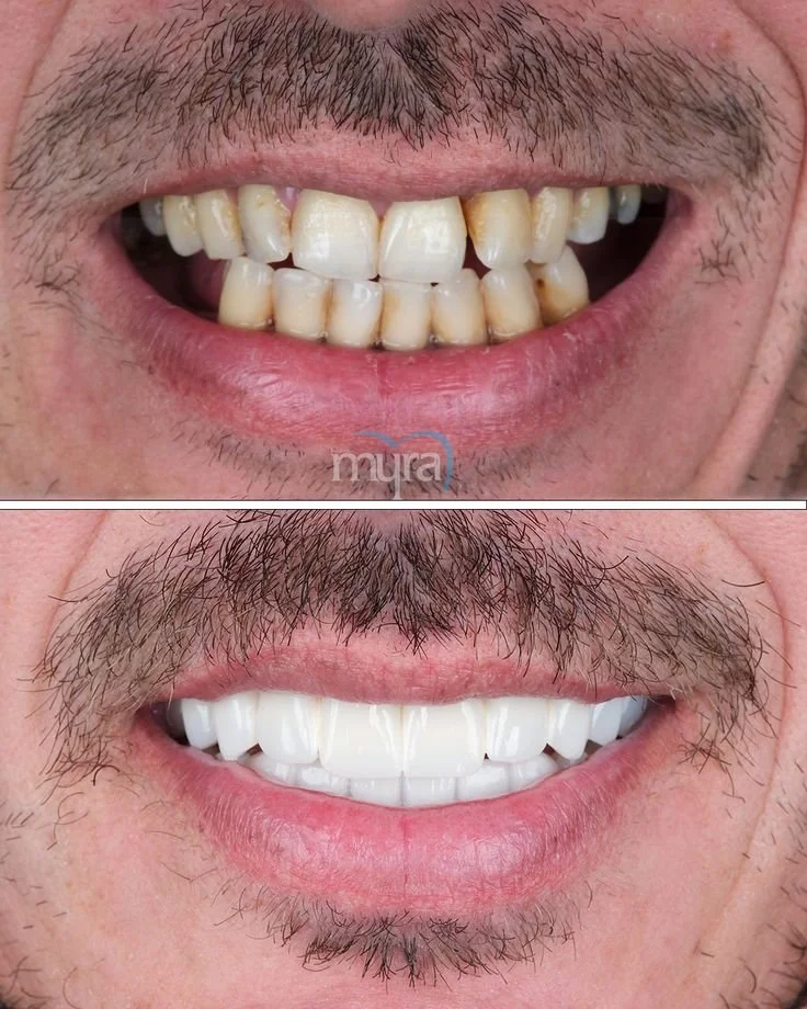 Before and after full mouth dental implants transformation demonstrating natural-looking tooth replacement.