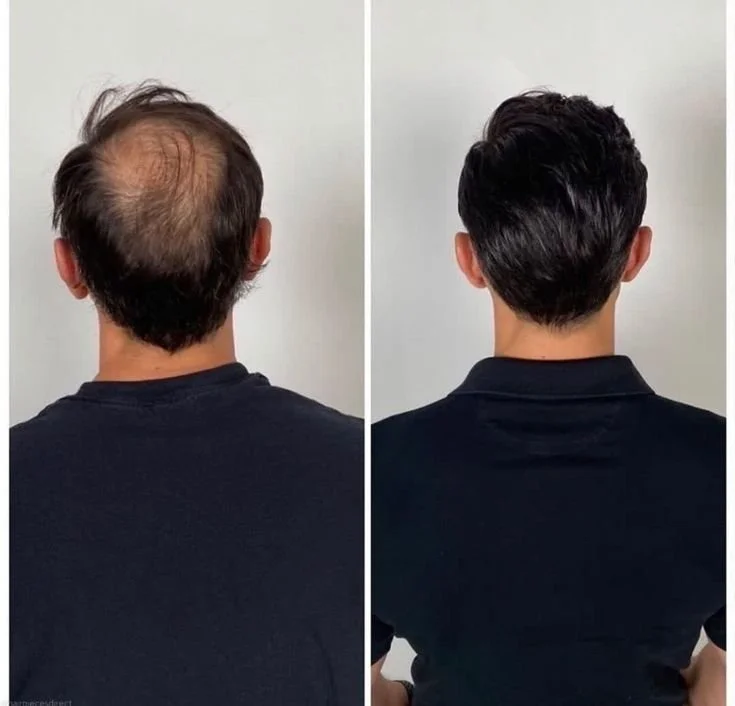 Sapphire FUE hair transplant before and after results showing natural hairline restoration in Turkey.