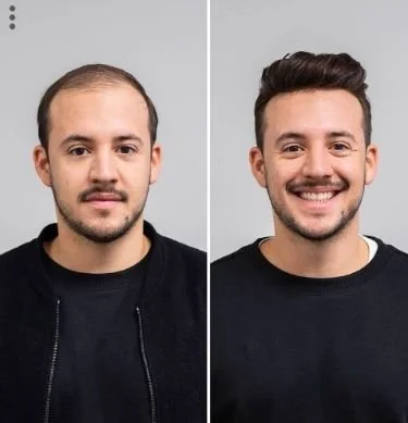 Professional hair transplant results from our partner clinics in Turkey, managed by our Scottsdale consulting team.