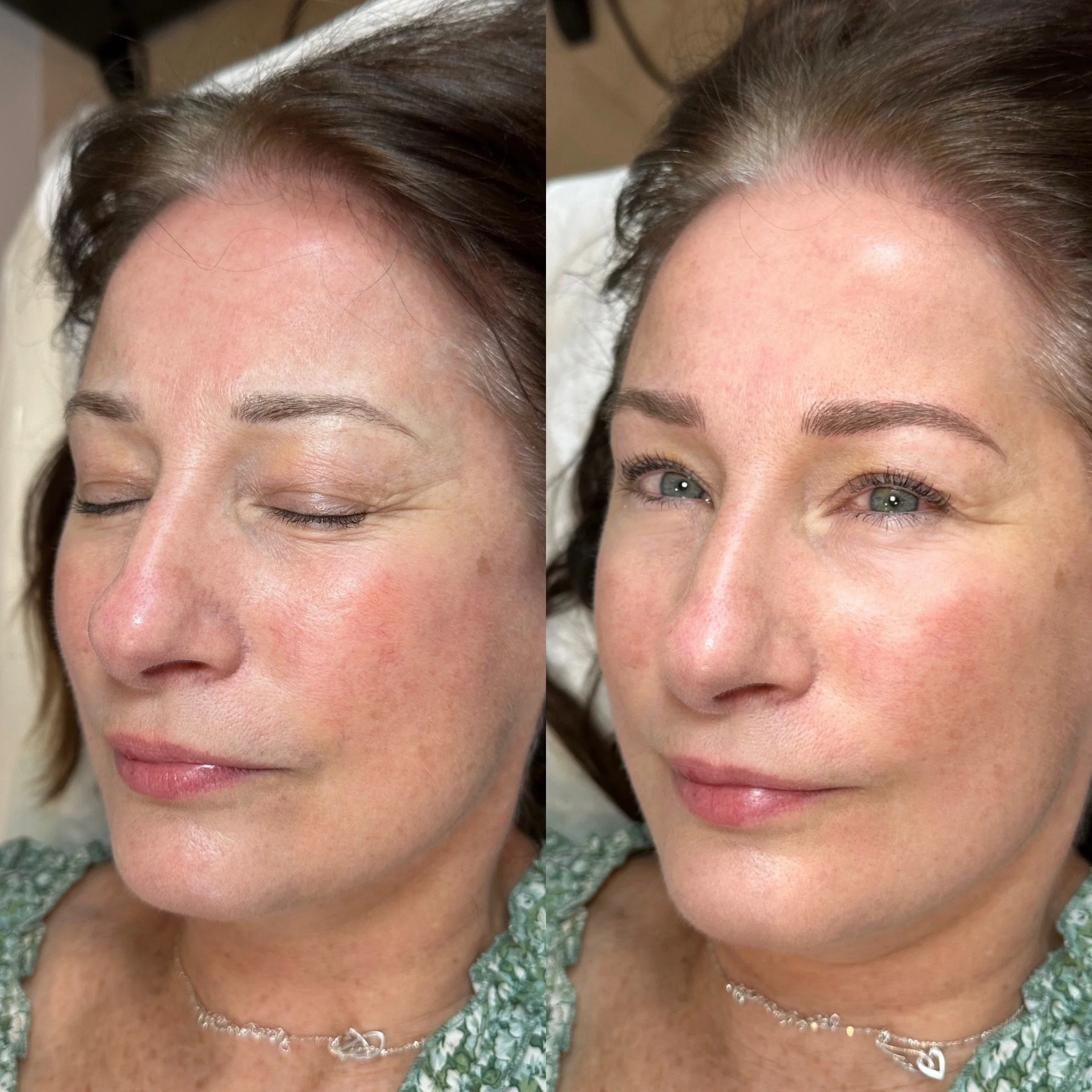 Side-by-side comparison of a woman's face before and after cosmetic treatment, showing improved skin texture and appearance.