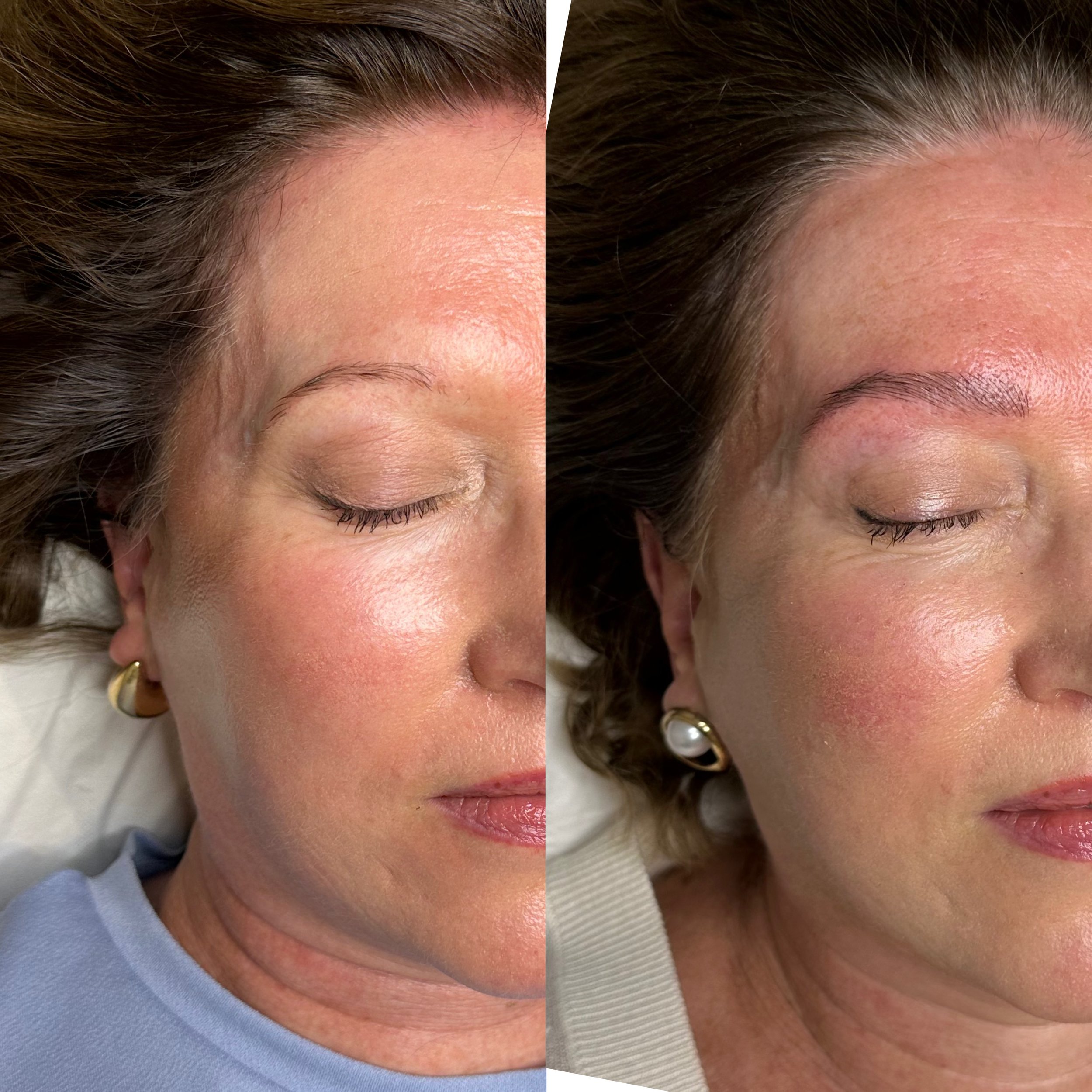 Close-up of a woman's face with visible skin imperfections before and after a cosmetic treatment, shown side by side, with her eyes closed and wearing earrings.