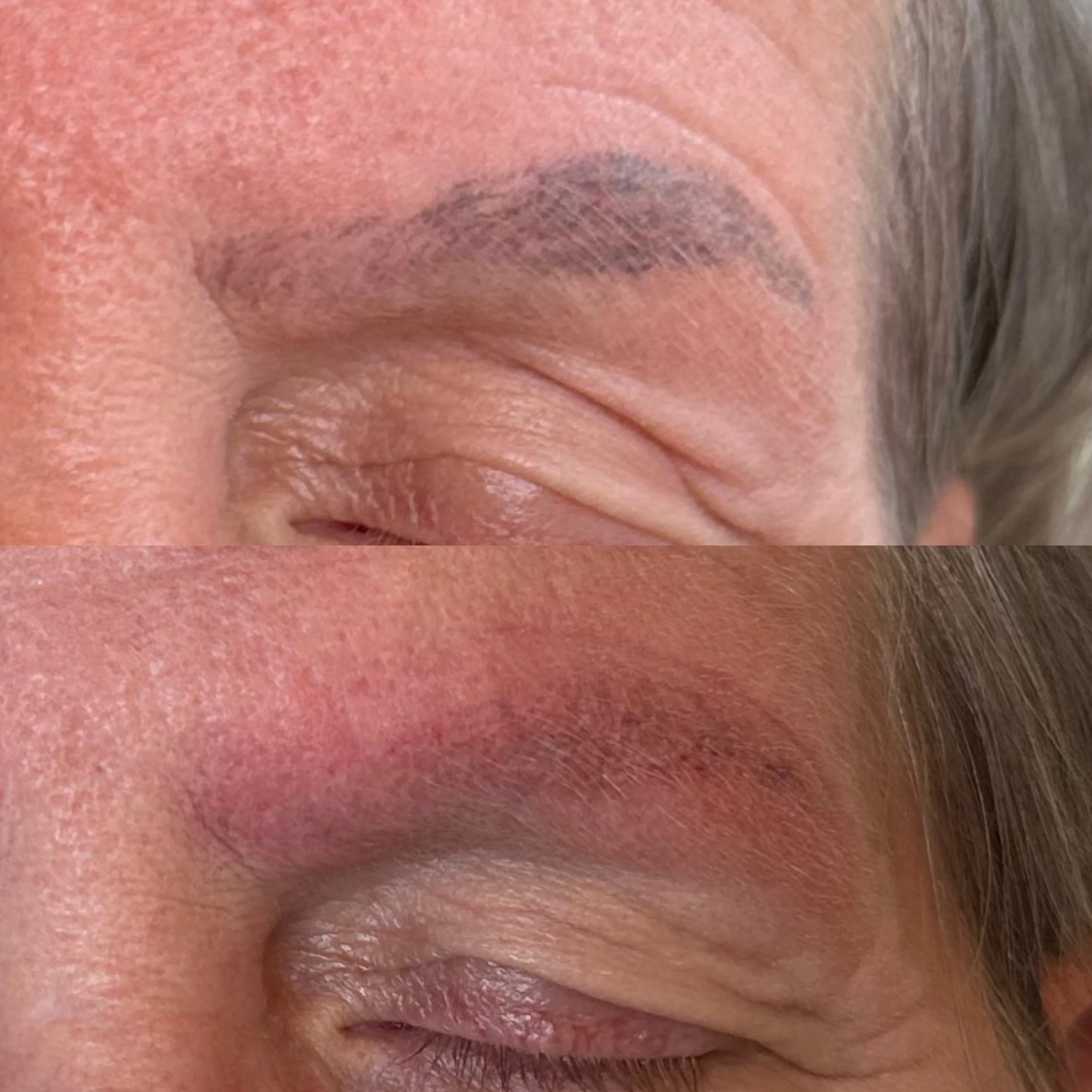 Laser Tattoo Removal of Unwanted Microblading