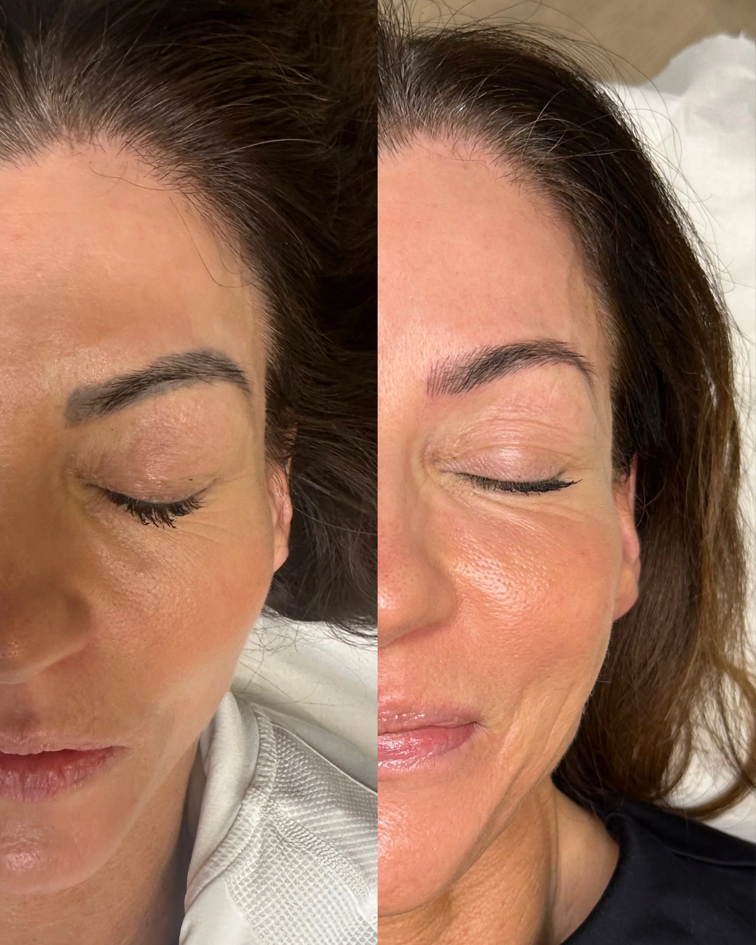 Blocky PMU removed and replaced with natural microblading