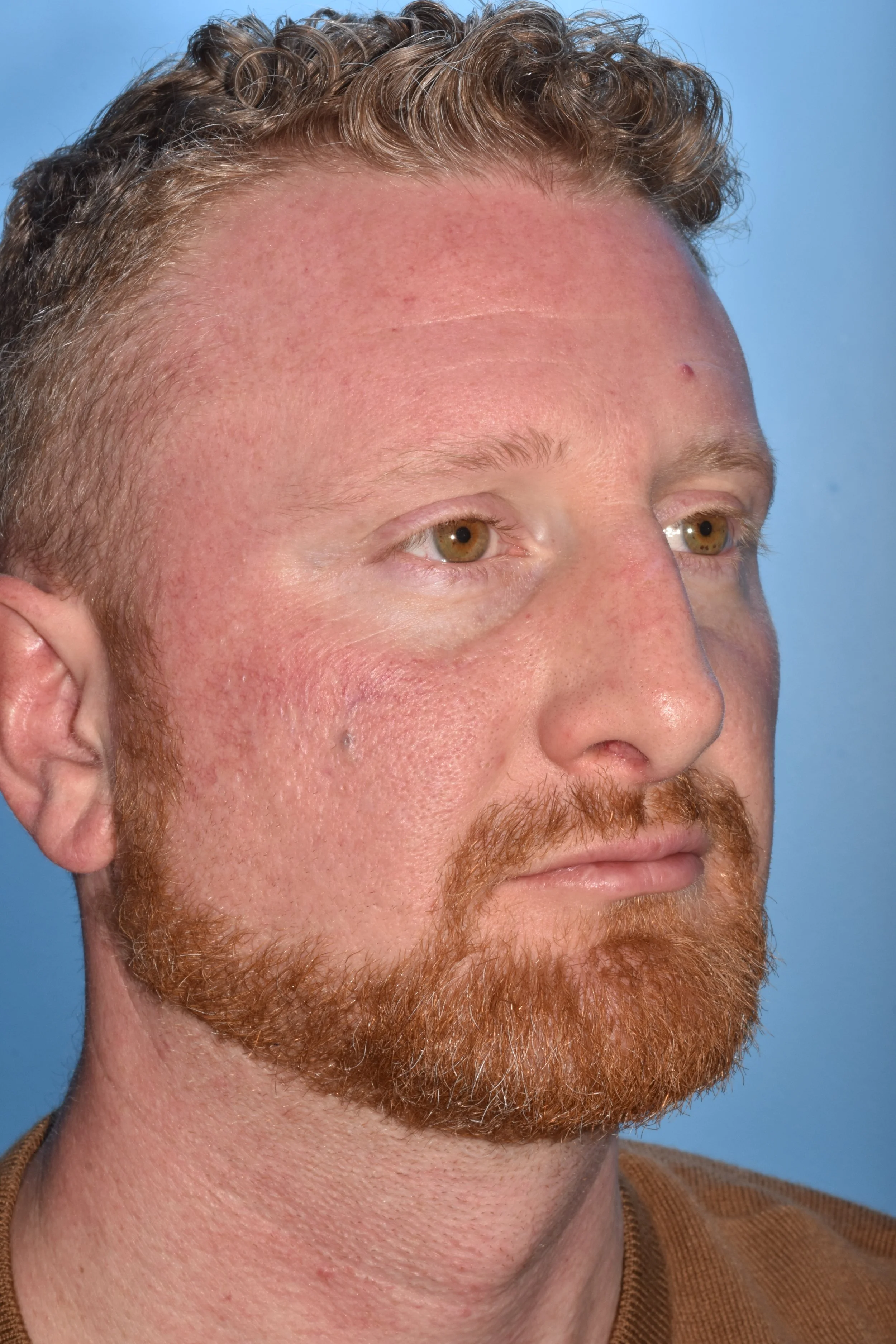 3m AFTER: Osteotomies. The caudal septum striped on the right side to reduce a concavity.  L small spreader graft. Onlay graft over left lower lateral cartilage. Clocking suture. Columella strut.