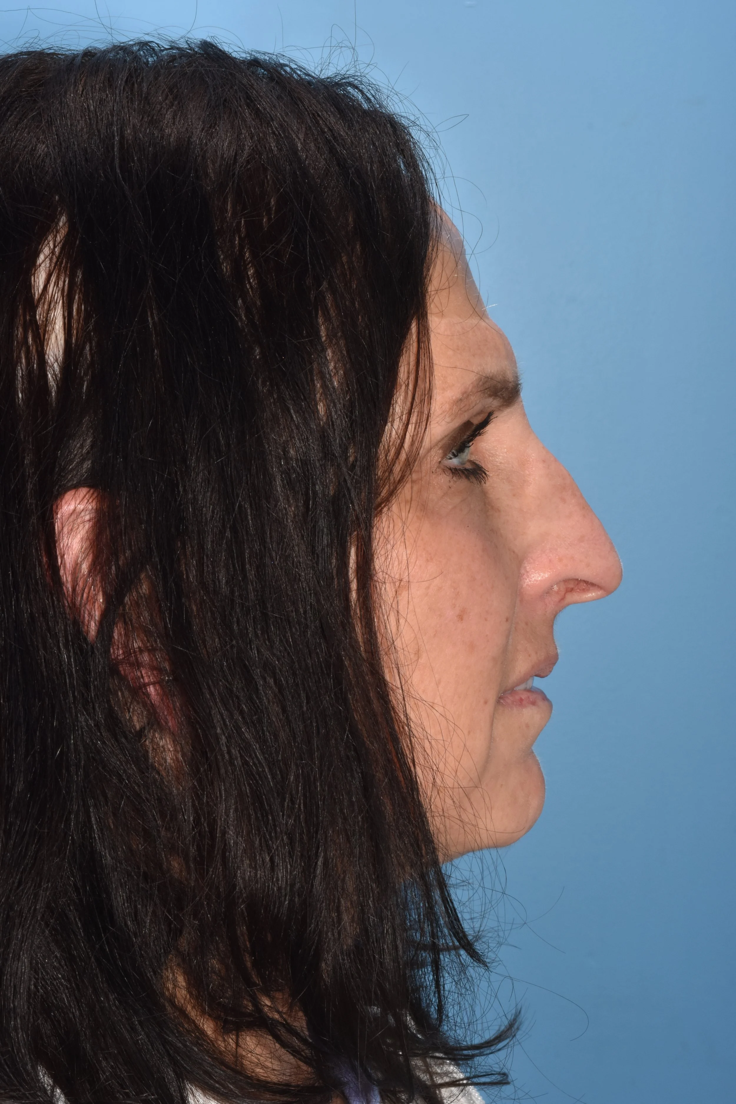 BEFORE: drooping nasal tip, overprojected dorsum