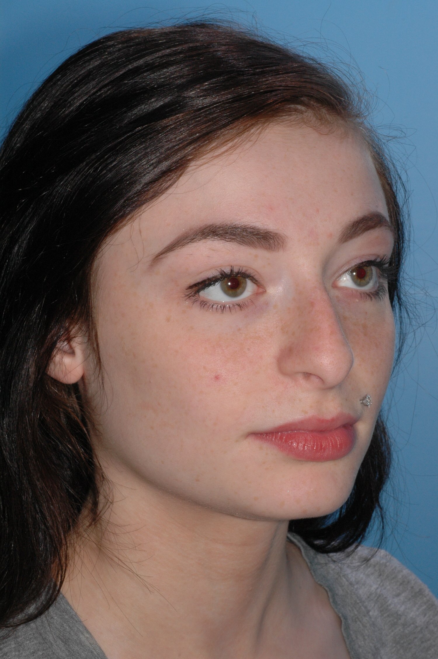 BEFORE rhinoplasty: droopy nasal tip, nasal hump
