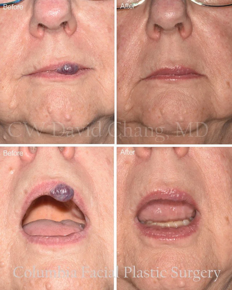 Removal of a cavernous hemangioma of the lip. No laser needed; just a scalpel and patience. &quot;After&quot; photos were taken 2 weeks post removal. Leaving a little residual may be preferred to creating a deformity. Will see how it heals over the n