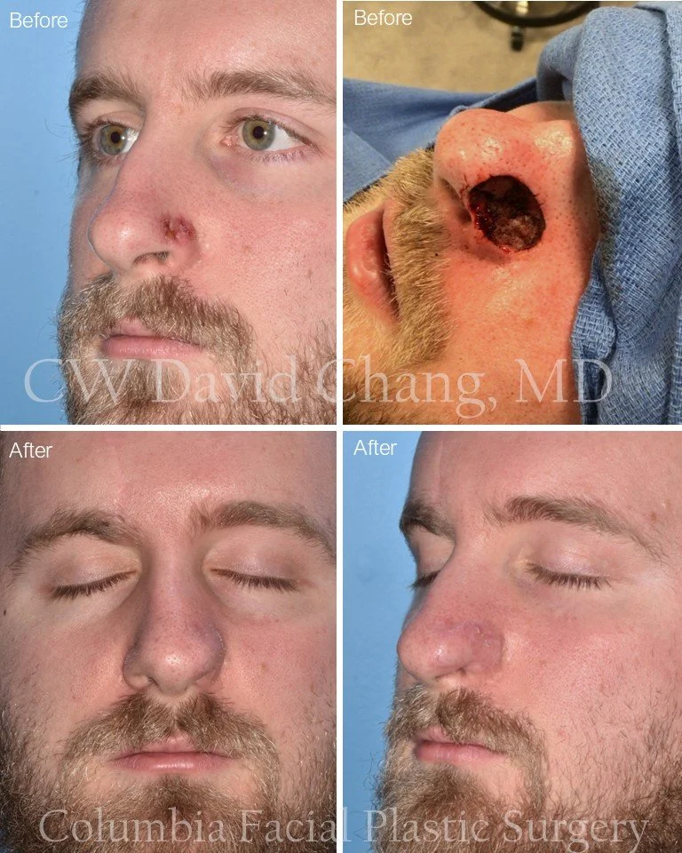 Skin cancer can be a devastating diagnosis&mdash;especially when it affects the nose, where both form and function are so vital.
I'm incredibly proud of this young man for his courage and resilience as he underwent a multi-stage forehead flap reconst