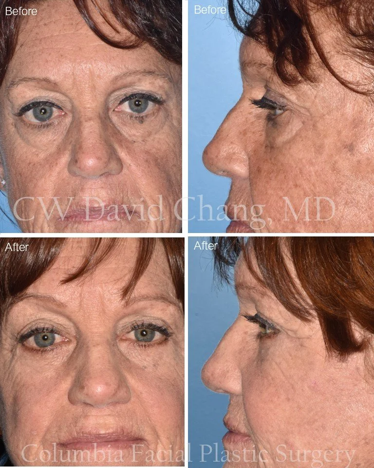 Tired of looking tired? Lower eyelid fat-repositioning #blepharoplasty uses your own natural fat to smooth out under-eye hollows and reduce the appearance of dark circles. By redistributing this fat, we restore youthful volume and soften those deep t