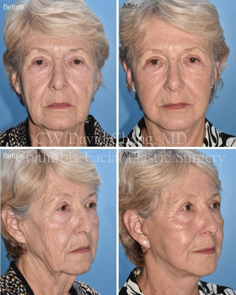 A rejuvenating look for a vivacious patient! Her new face (right) better matches her youthful energy! Thanks for letting us show your transformation. #deepplanefacelift