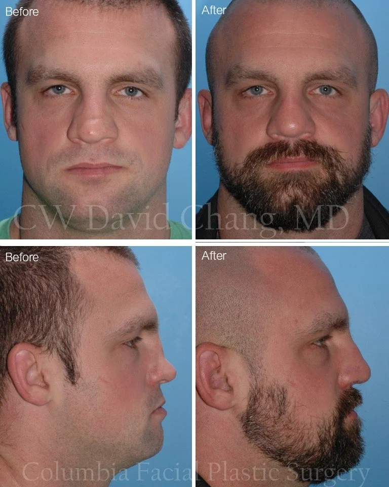 Fixing nasal bridge collapse