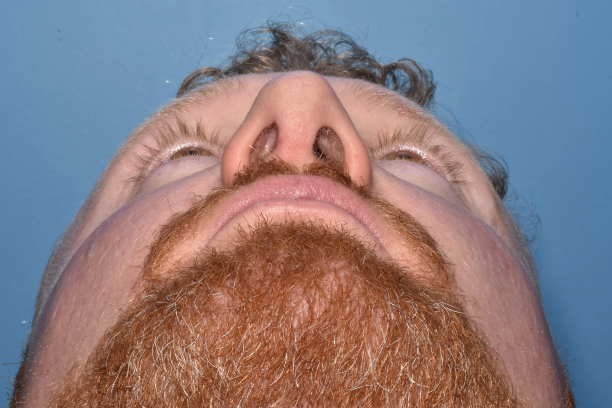 3m AFTER: Osteotomies. The caudal septum striped on the right side to reduce a concavity.  L small spreader graft. Onlay graft over left lower lateral cartilage. Clocking suture. Columella strut.