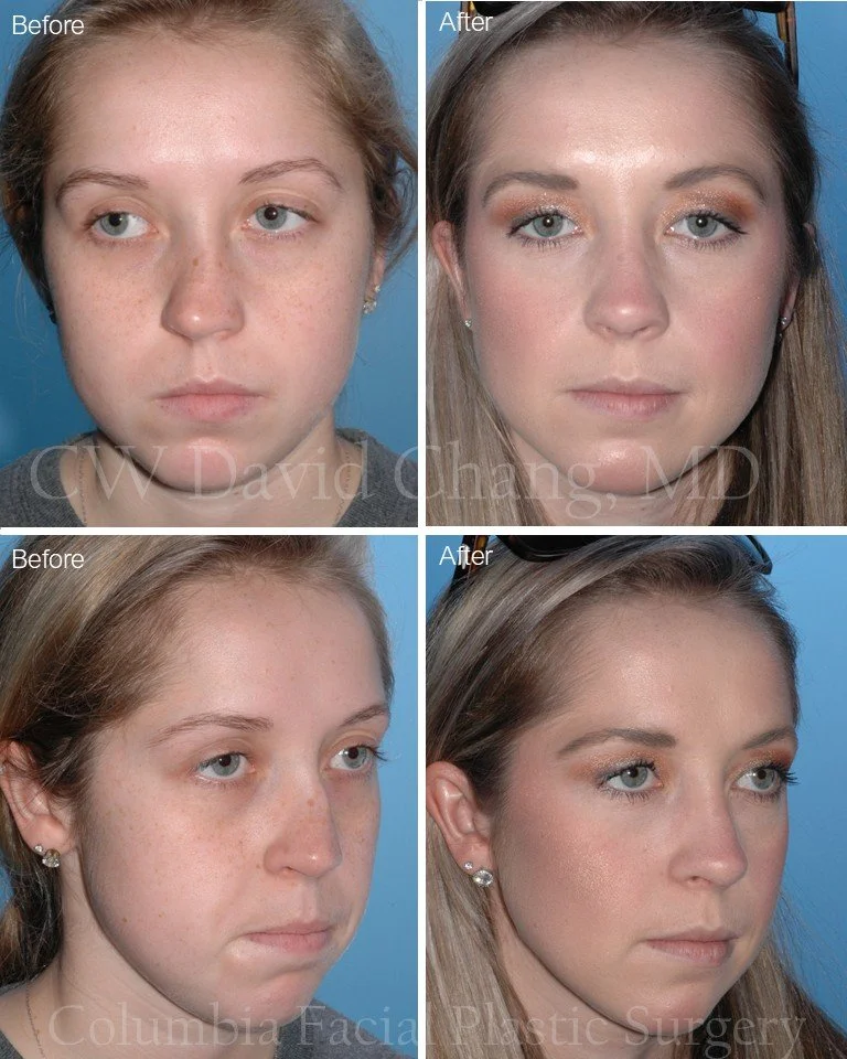 3 YEARS AFTER | Functional + Structural Rhinoplasty

3-year postoperative result following extracorporeal septoplasty to improve form and function. Pre-operatively, the nose was severely twisted, and the septum was blocking the nasal passage.

Post-o