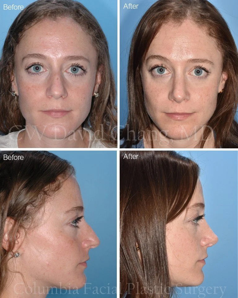 It&rsquo;s Facial Plastics Friday! ✨
A rhinoplasty to remove the dorsal hump and elevate the nasal tip can create just the right refinement &mdash; all while keeping results natural and balanced.

#Rhinoplasty #NoseJob #NasalRefinement #DorsalHumpRem