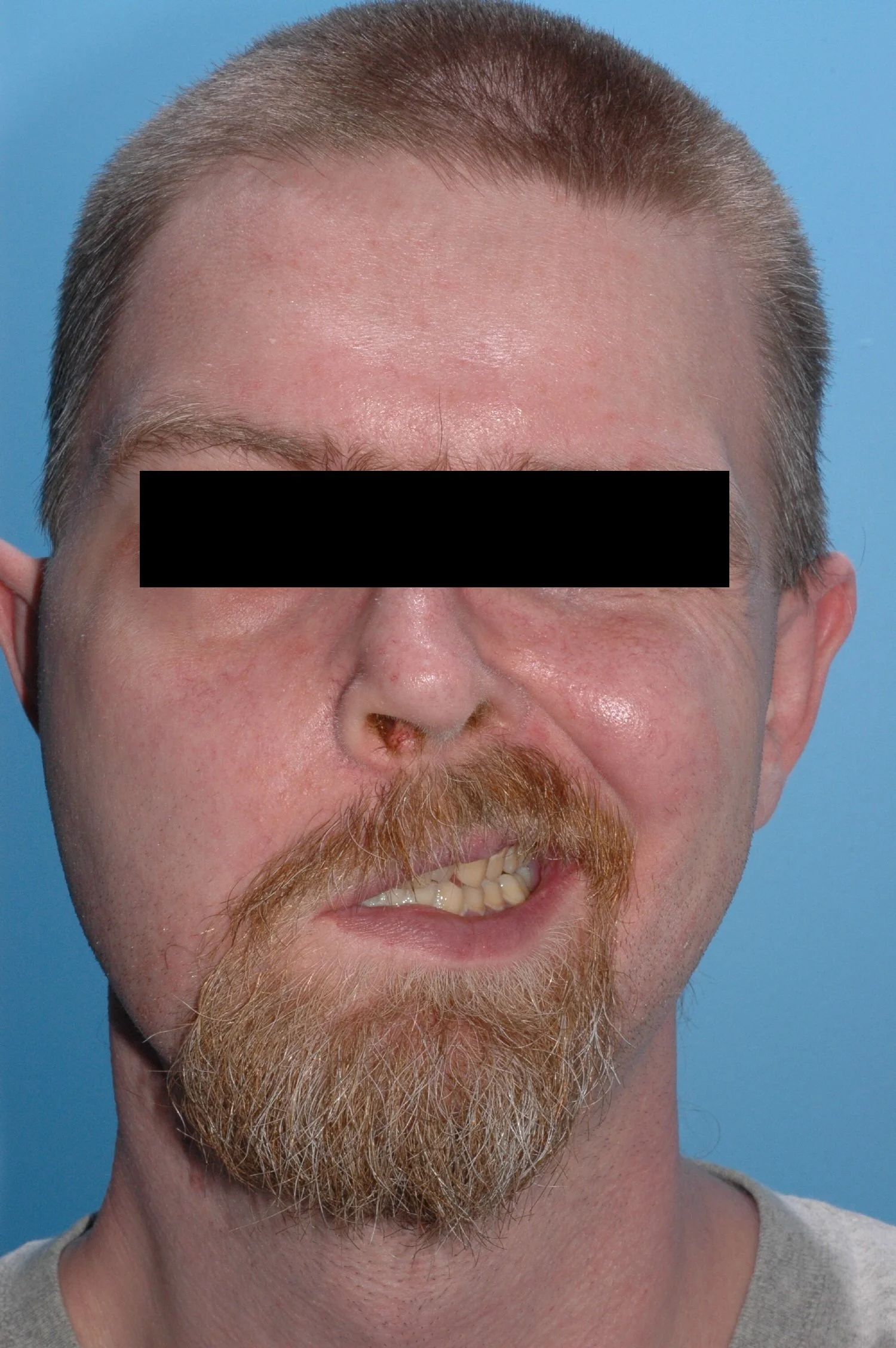 CN V-VII transfer for facial paralysis