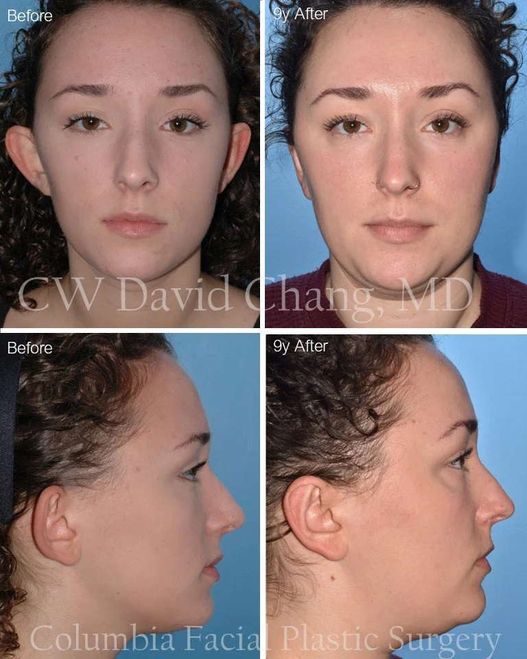 ✨ 9‑Year Otoplasty Follow‑Up! ✨
It&rsquo;s always rewarding to see long‑term results, and this 9‑year postoperative update is a great example of how well otoplasty can hold over time. 

Grateful for patients who return years later and allow us to doc