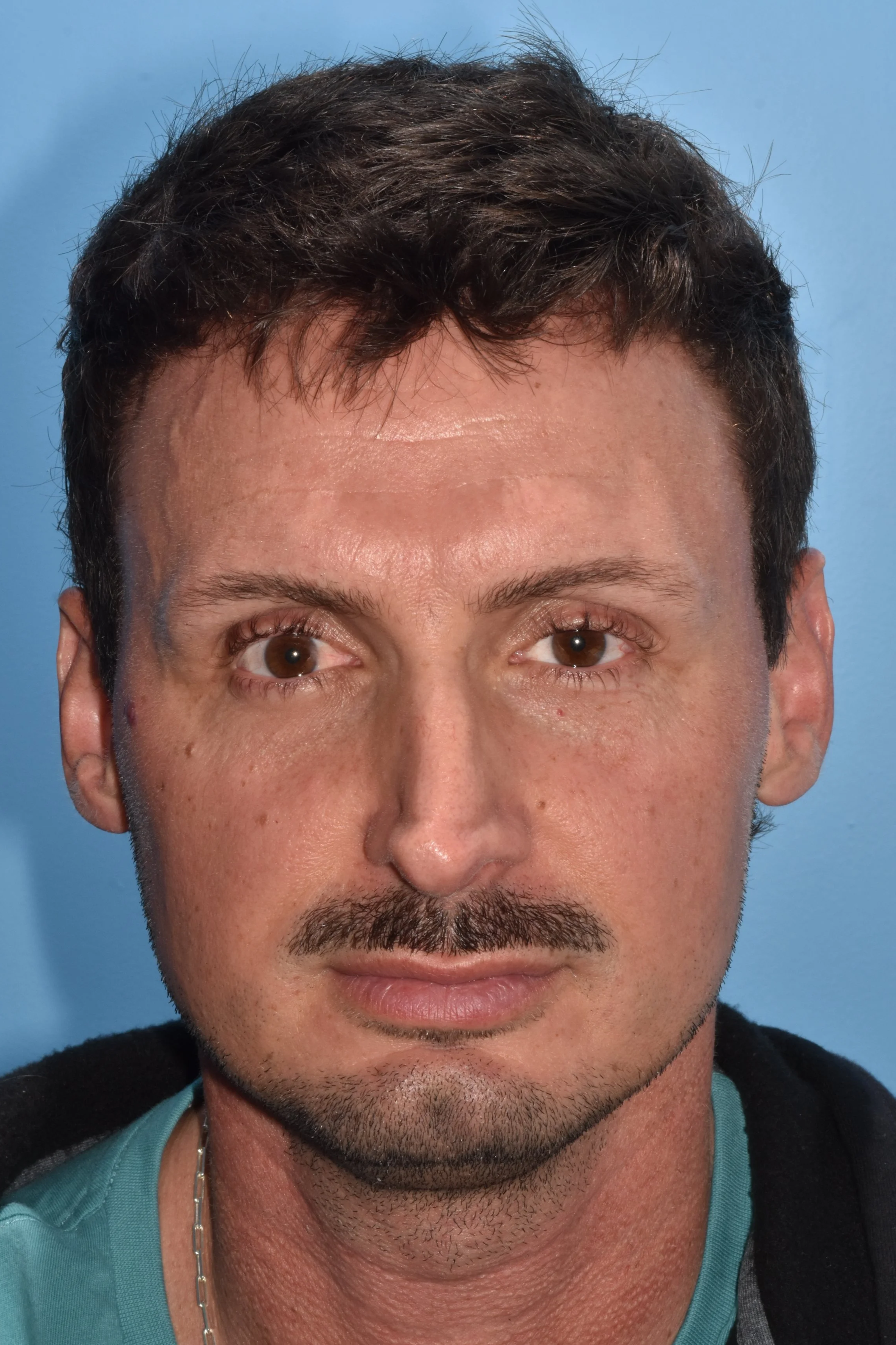 BEFORE (twisted nasal tip, concave lateral crura, external nasal valve collapse)