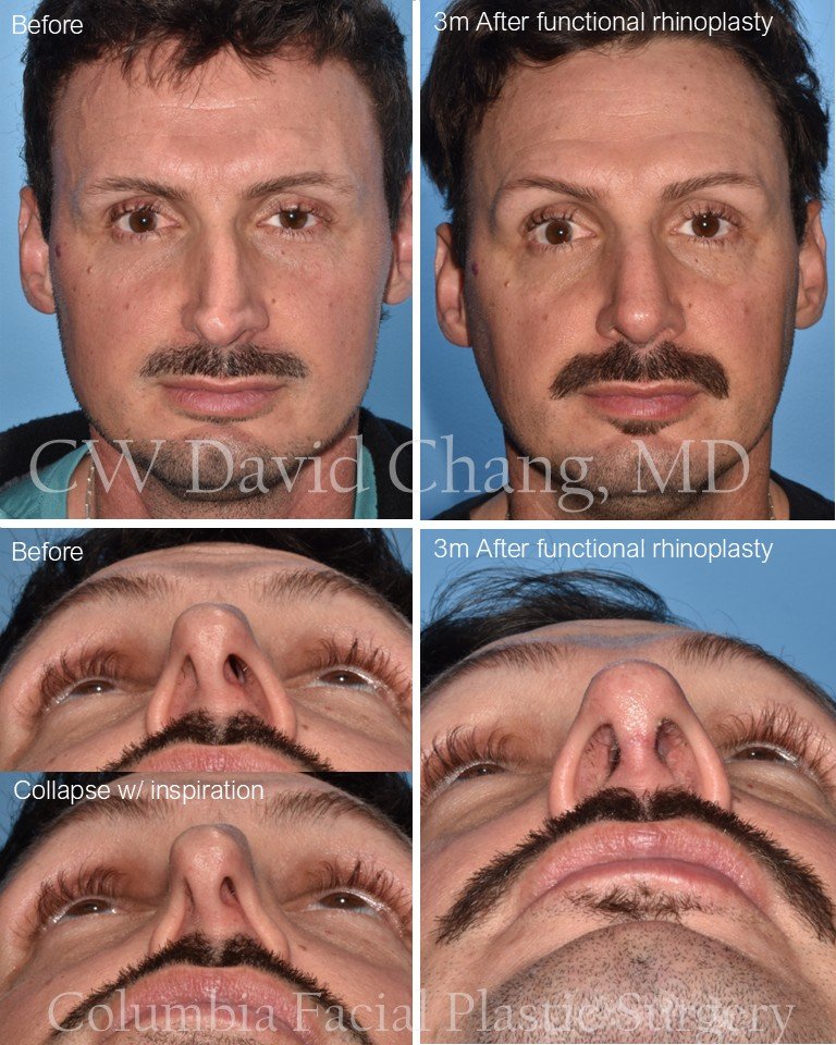 Functional rhinoplasty can provide improvement in nasal breathing (and appearance)!
BEFORE: twisted nasal tip, concave lateral crura, external nasal valve collapse upon inspiration
3m AFTER functional rhinoplasty: flattened/strengthened lateral crura