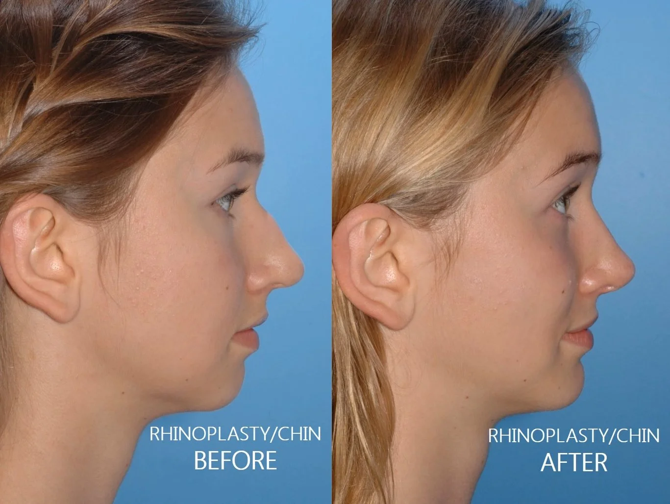 What is Rhinoplasty?