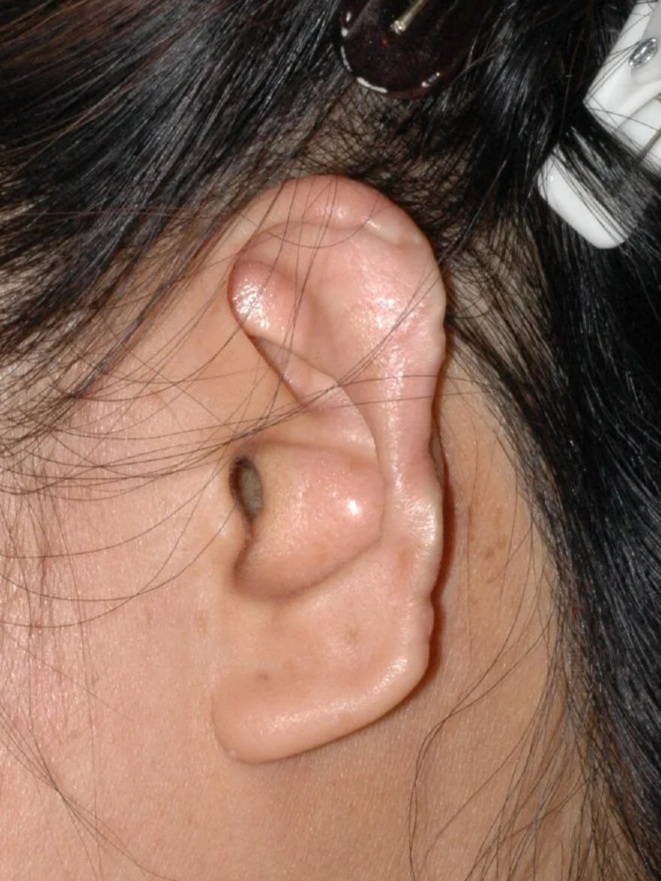 BEFORE: partial amputation of helical rim after dog-bite injury