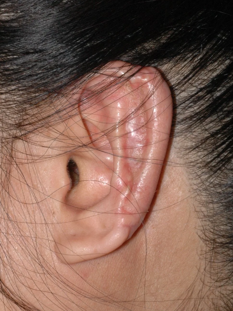 AFTER: rib reconstruction of ear, 2 stages.