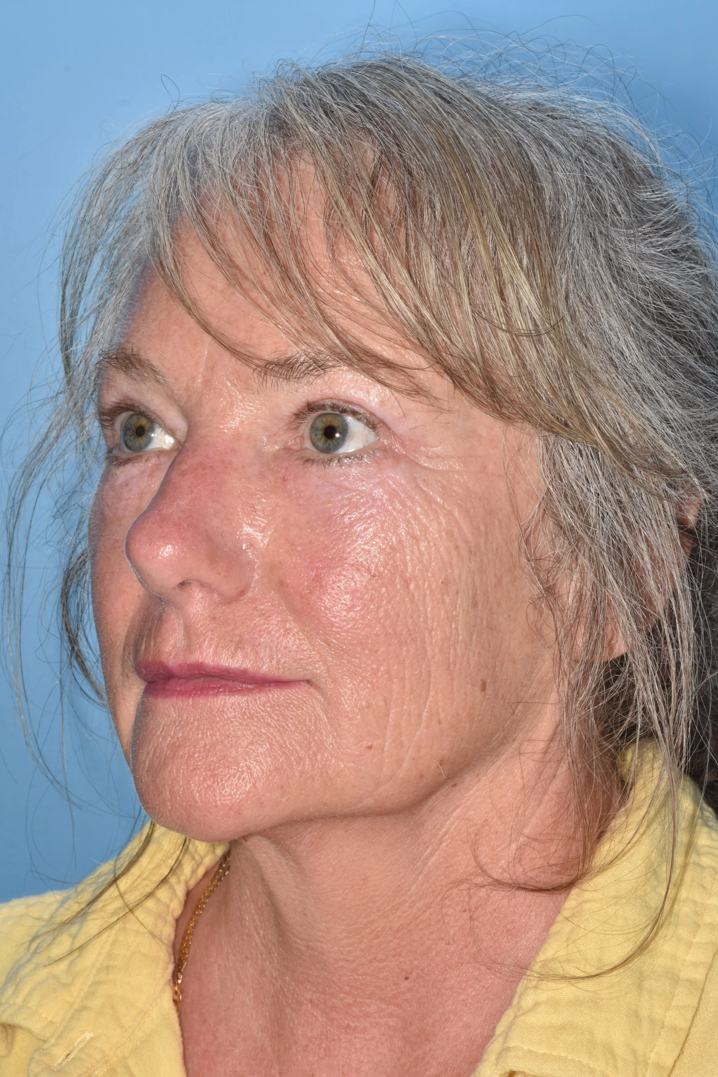 What is fat-repositioning lower eyelid blepharoplasty?