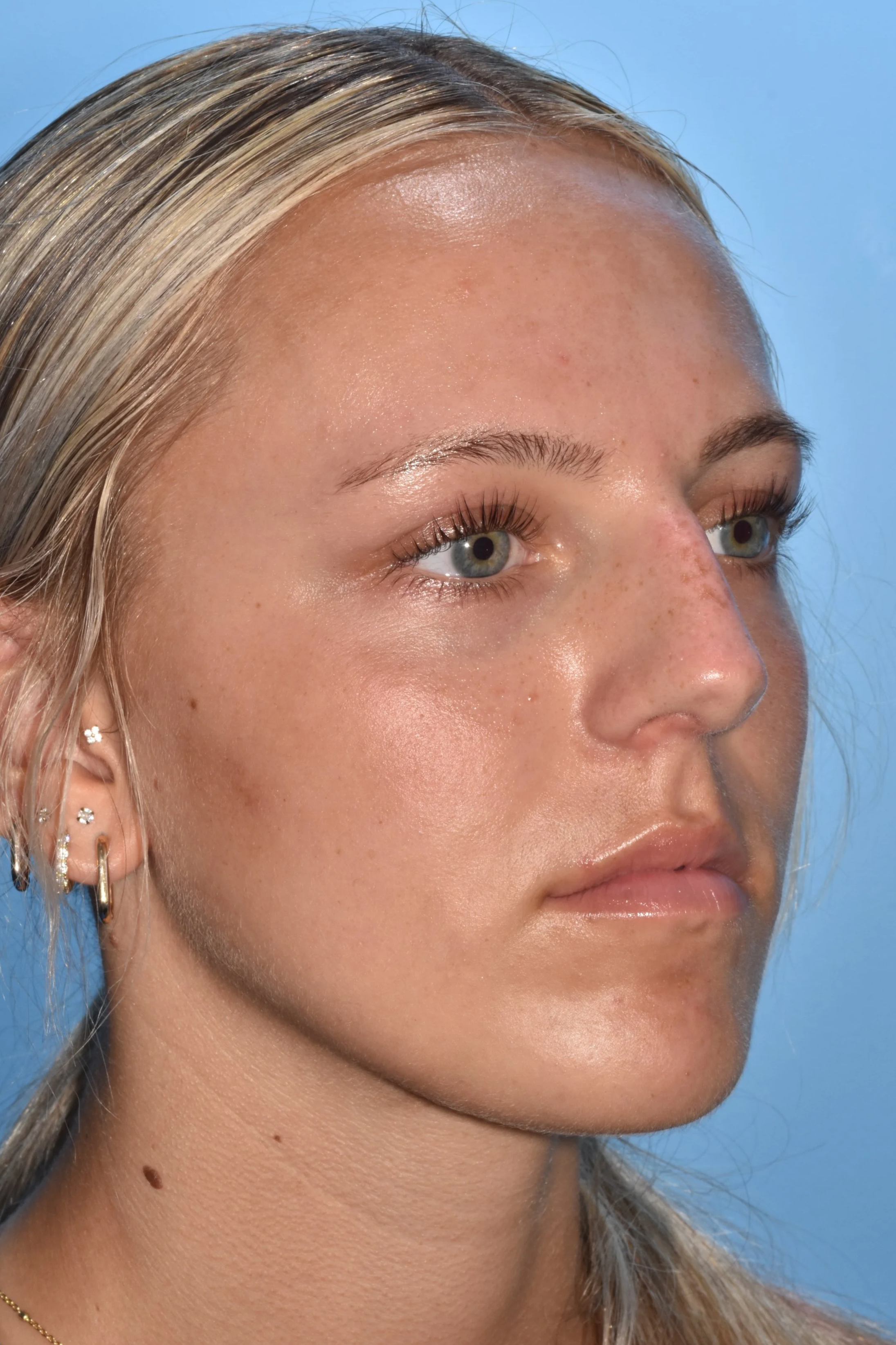 BEFORE Rhinoplasty