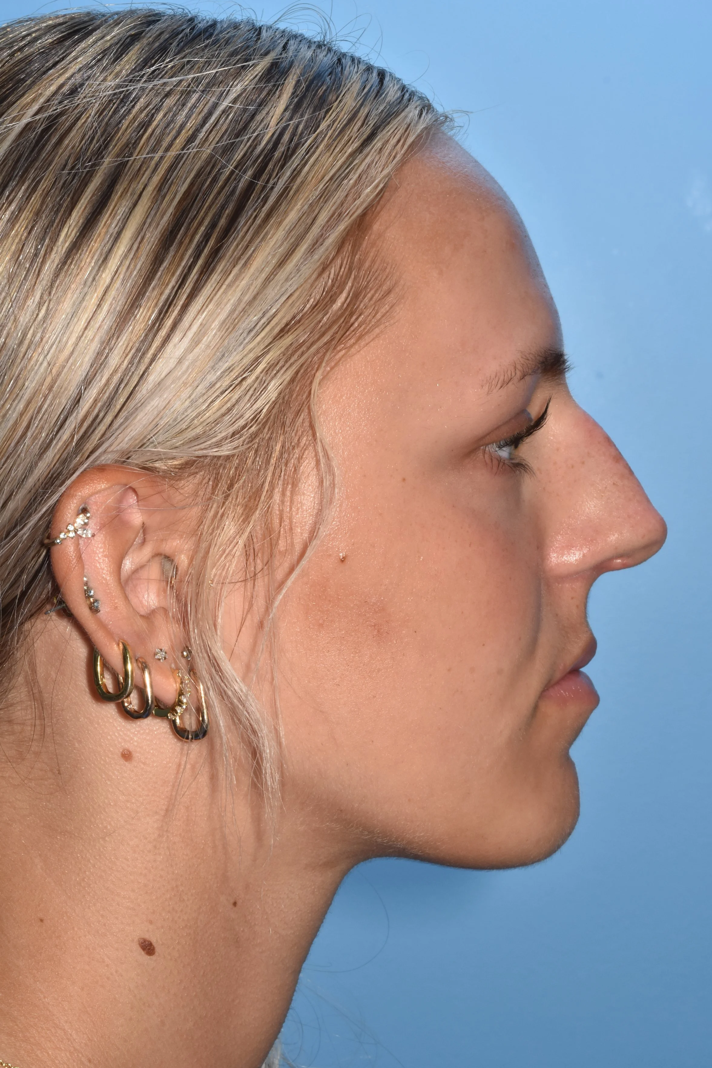 BEFORE Rhinoplasty