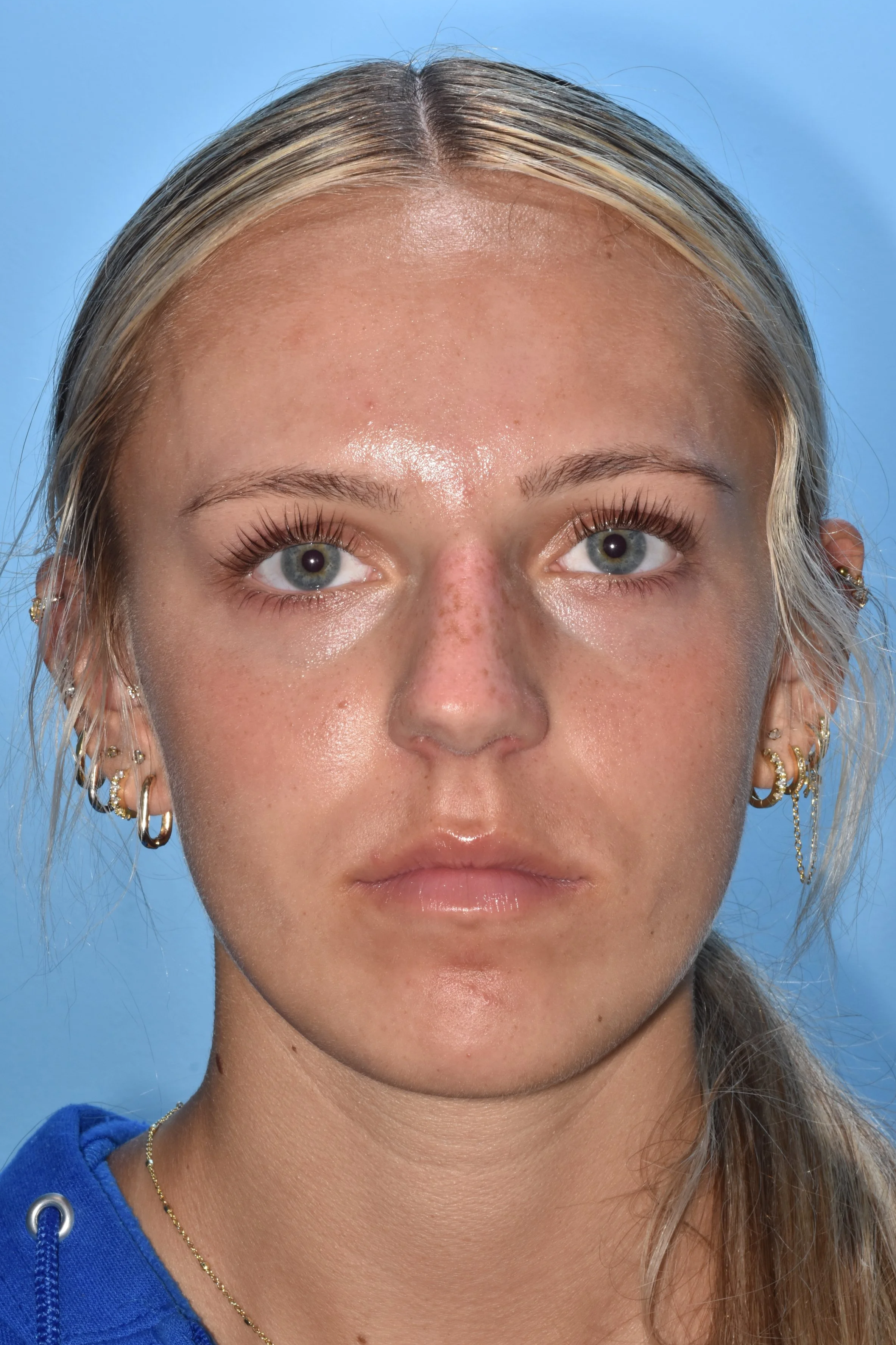BEFORE Rhinoplasty