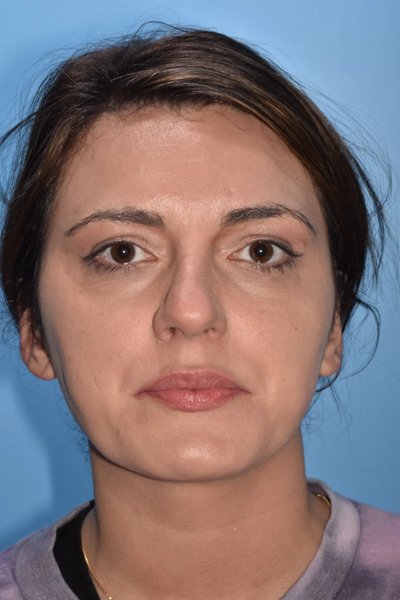 BEFORE rhinoplasty