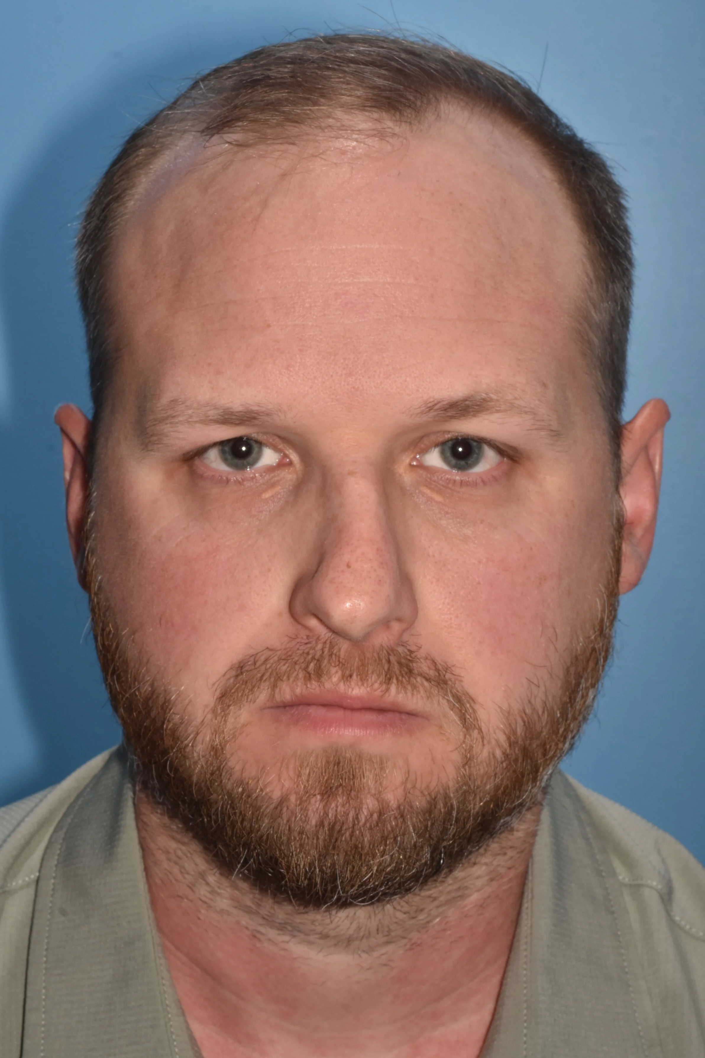 BEFORE functional rhinoplasty