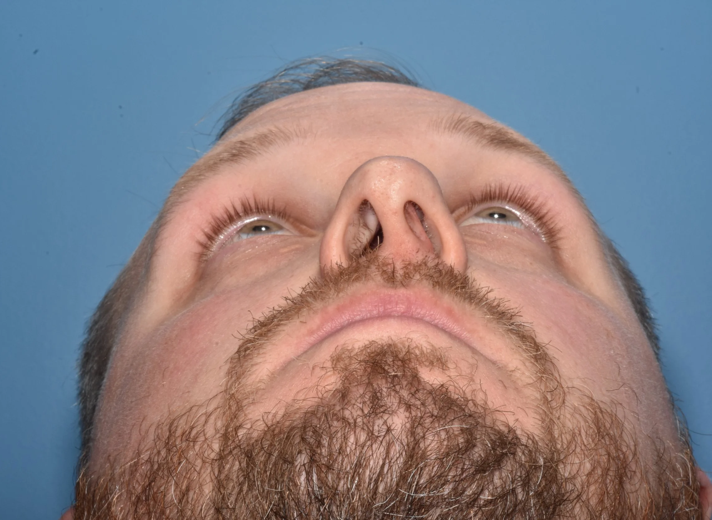 BEFORE functional rhinoplasty