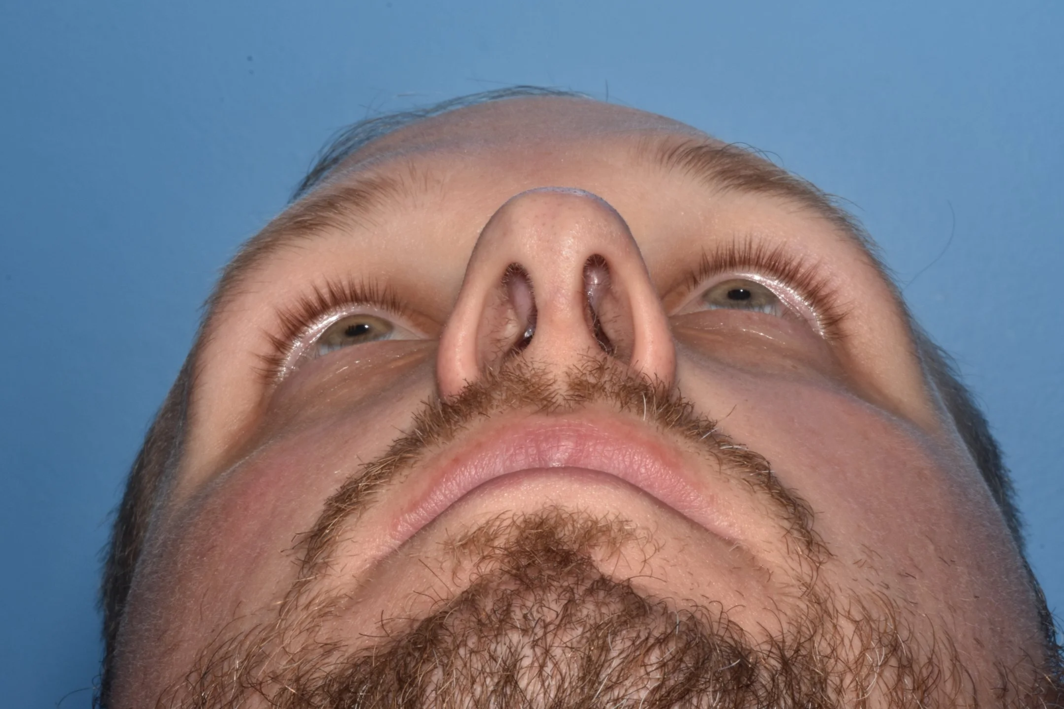 AFTER functional rhinoplasty (reduce tip twist, center caudal septum)