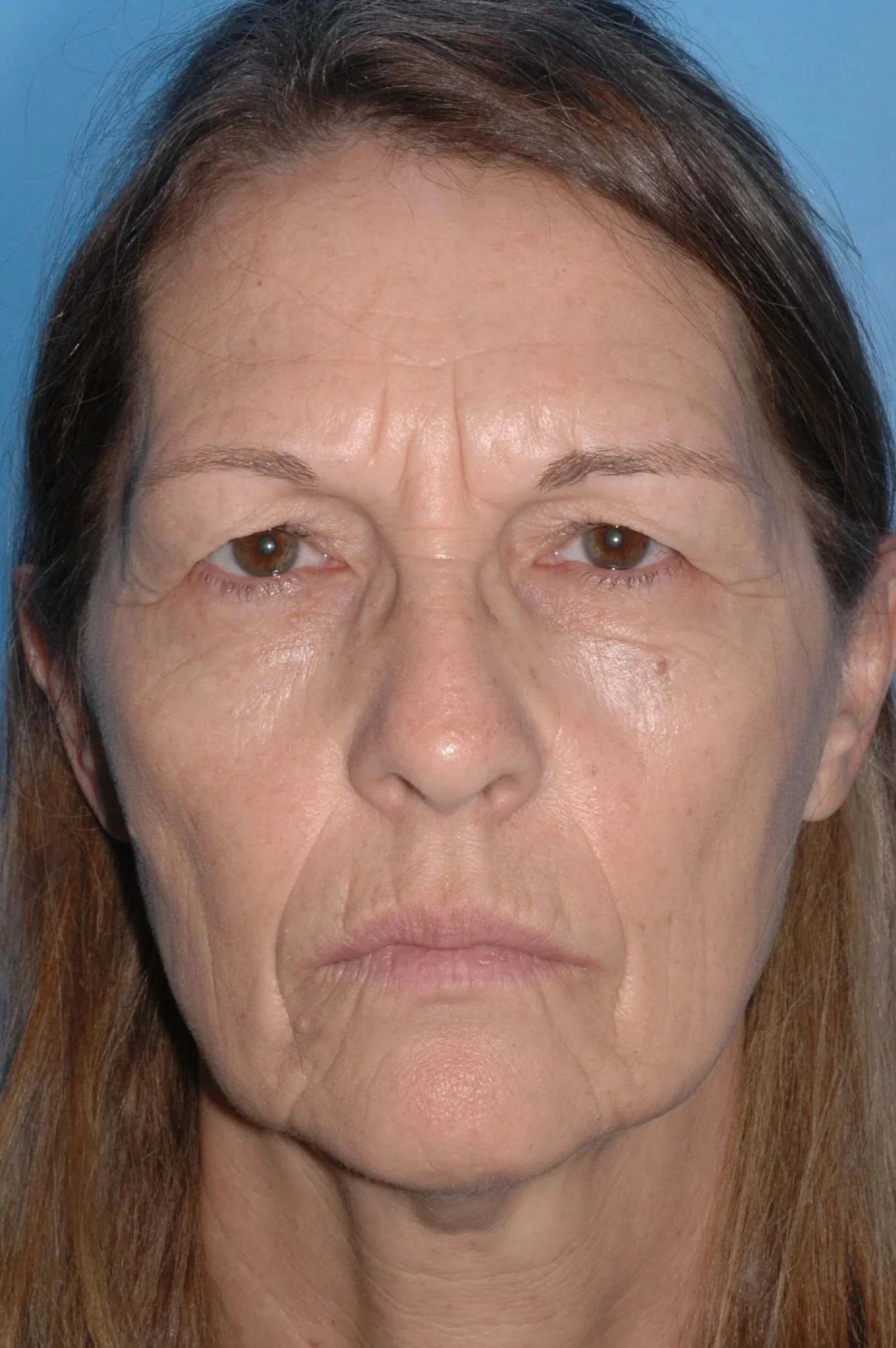 BEFORE upper lid blepharoplasty
