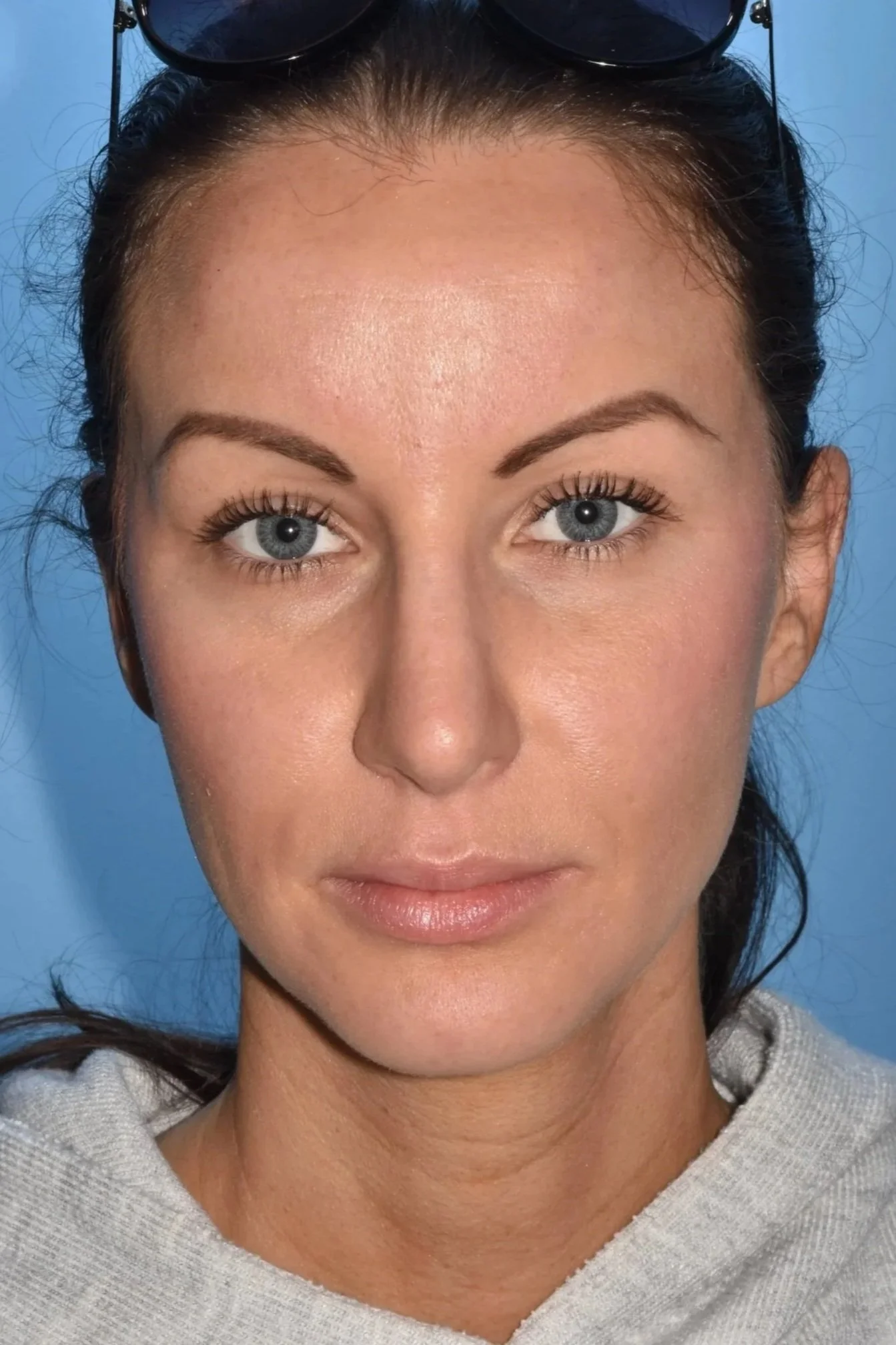 2.5 y AFTER rhinoplasty (hump reduction, breathing improvement)