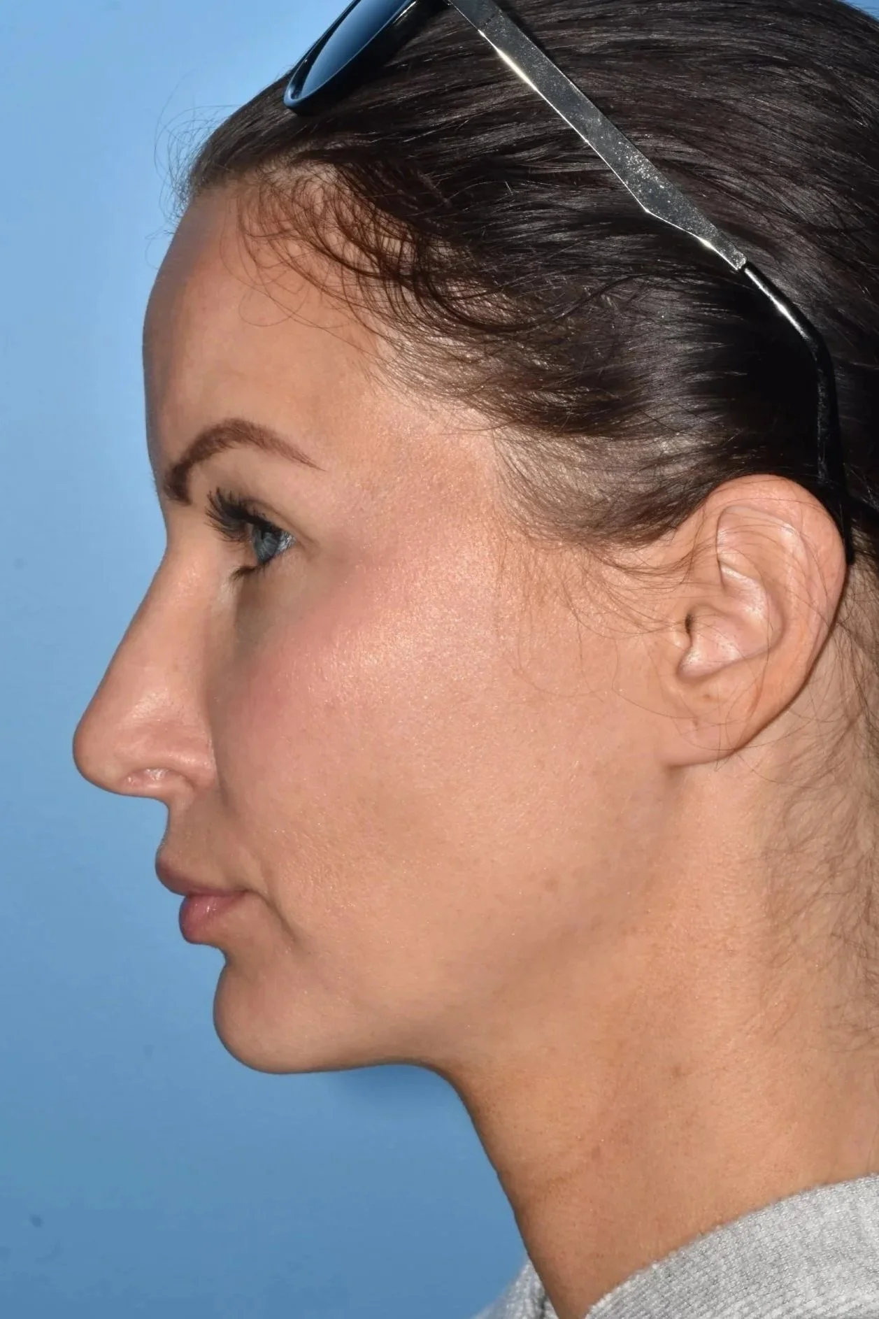 2.5 y AFTER rhinoplasty (hump reduction, breathing improvement)